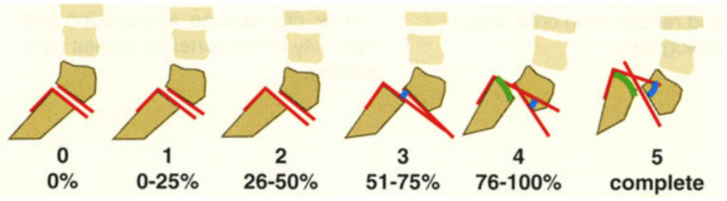 5-grades-of-spondylolisthesis-1024x284