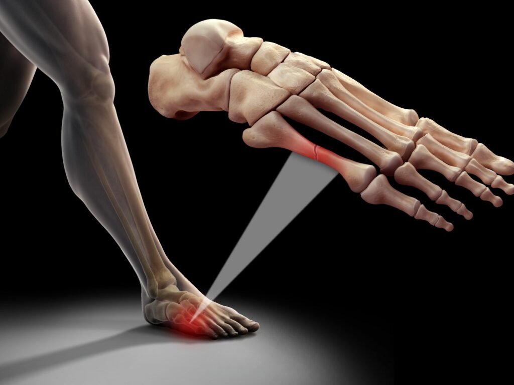 bone-stress-fracture-in-the-fifth-metatarsal-1024x768
