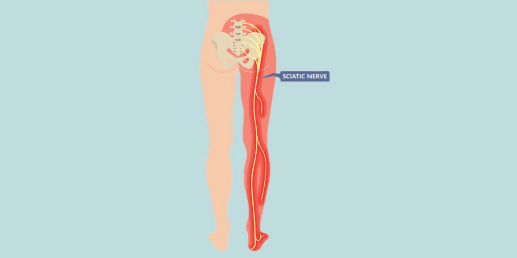 Sciatica-1-1024x512