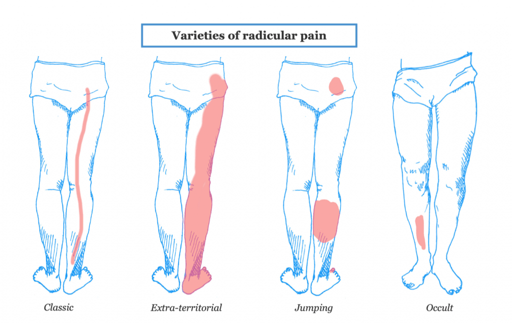 radicular-pain-types-1024x646