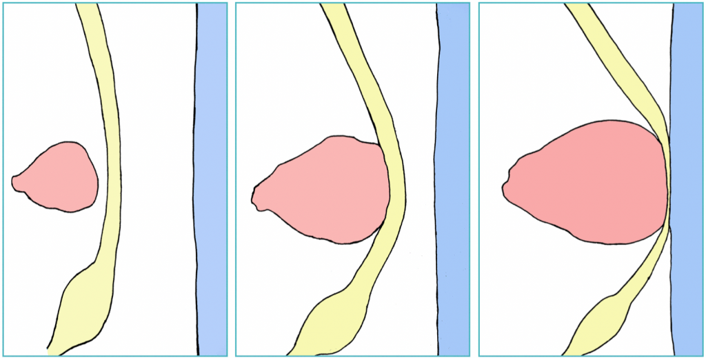 sciatica-types