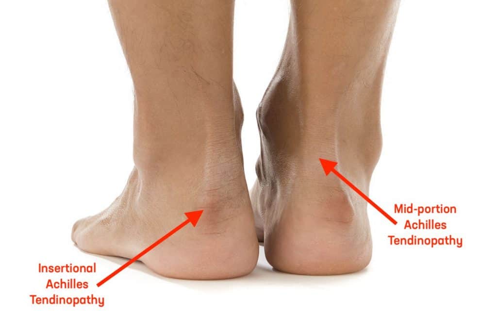 achilles-tendinopathy