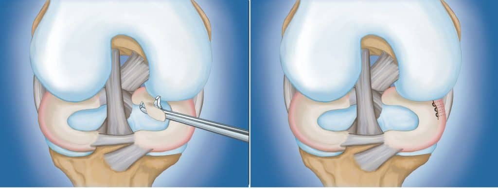 meniscus-repair-1024x389