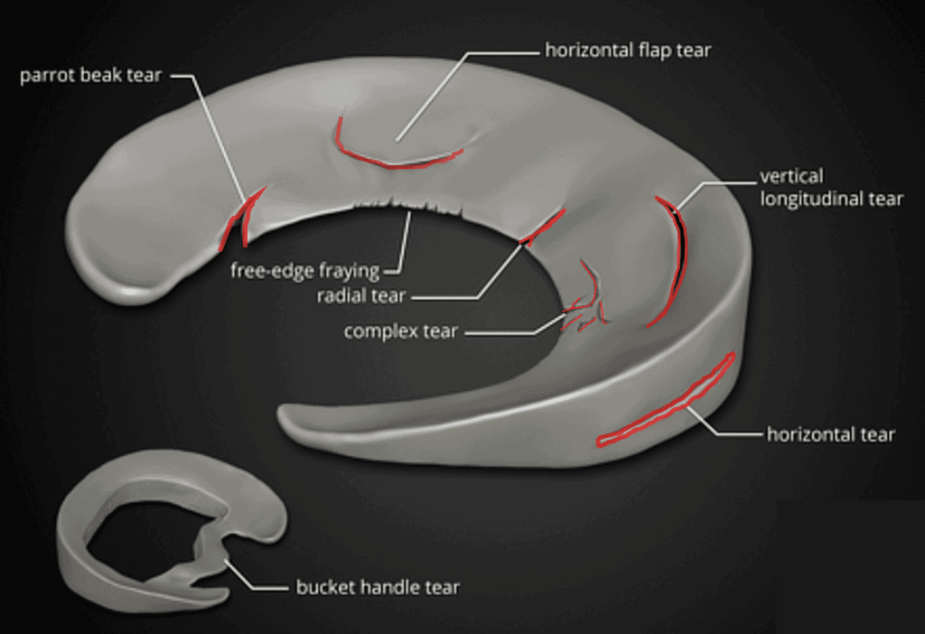 meniscus-tear-types-min-1024x702