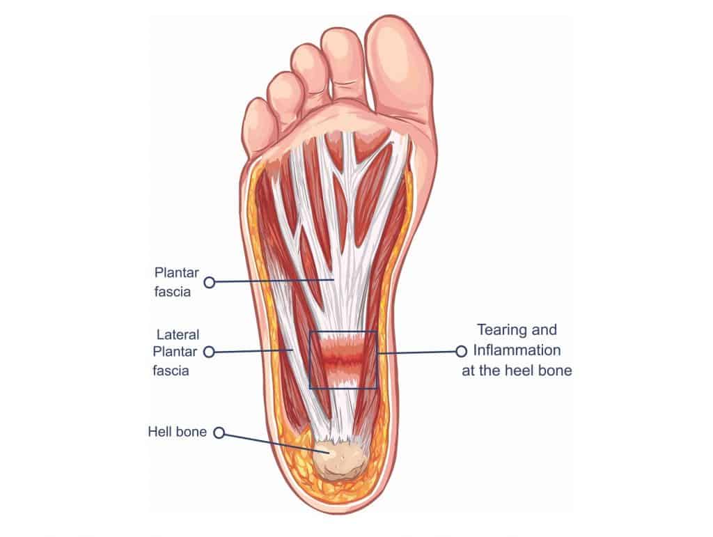 treat-plantar-fasciitis-1024x771