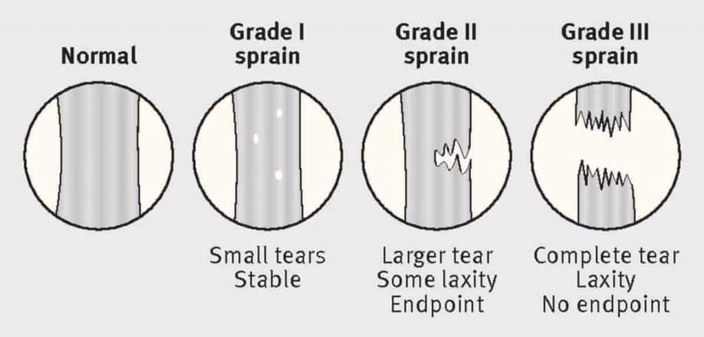 Ligament-tear-grades-1024x491