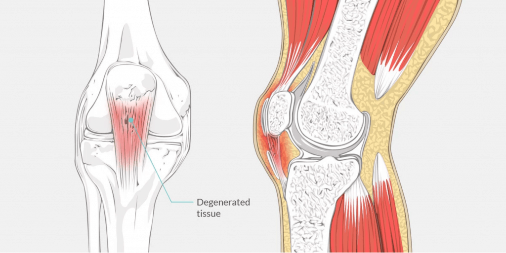 patellar-tendon-pain-diagram-1024x513