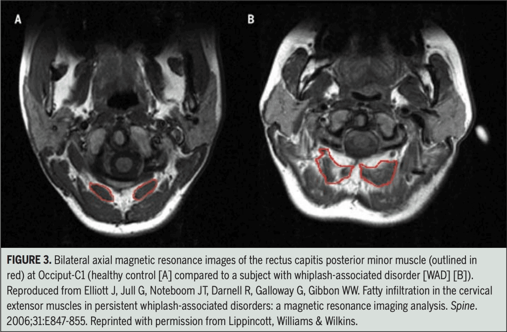 neck-pain-MRI-fatty-infiltrate-in-the-muscle-1-1024x671