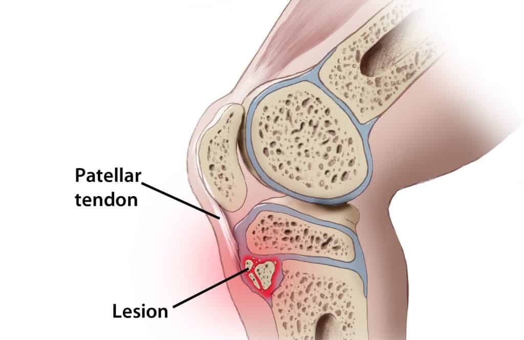 Osgood-Schlatter-disease_physiotherapy-toronto