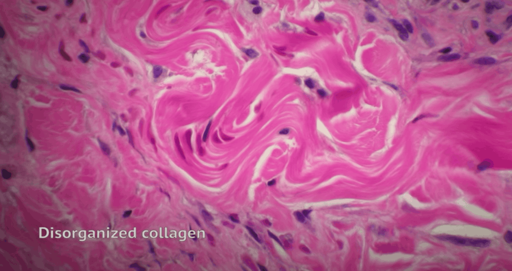 Degenerative-tendon-1024x542