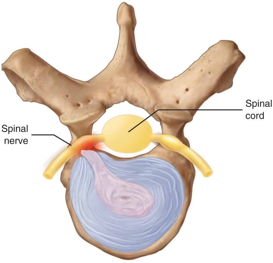 disc-herniation-min-e1591384105389