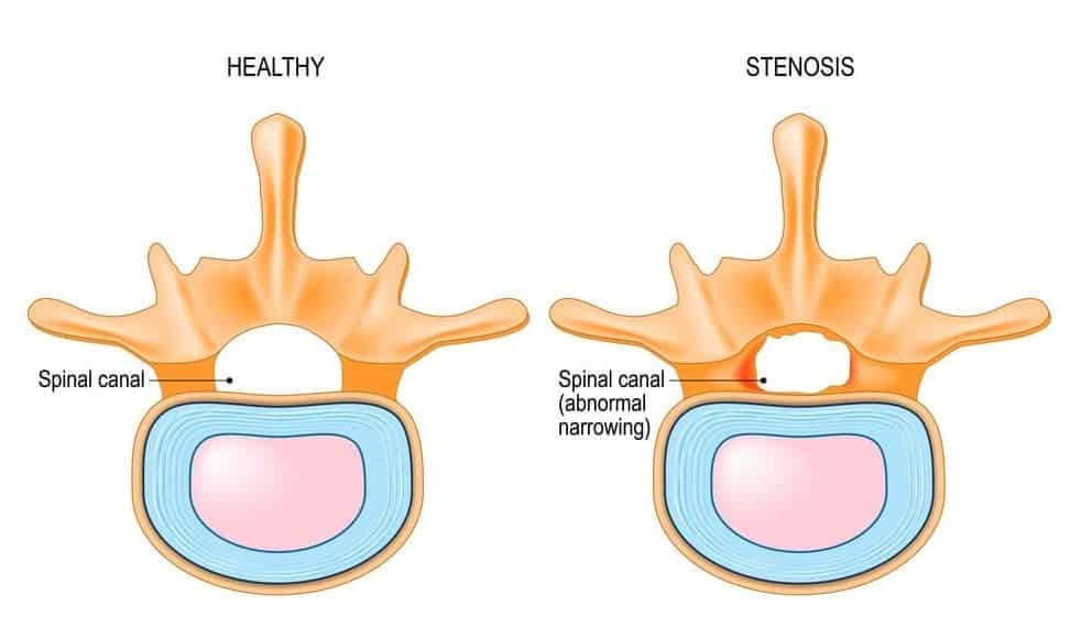 spinal stenosis