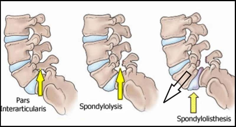 Spondylolisthesis-spondylolysis-pars-interarticularis