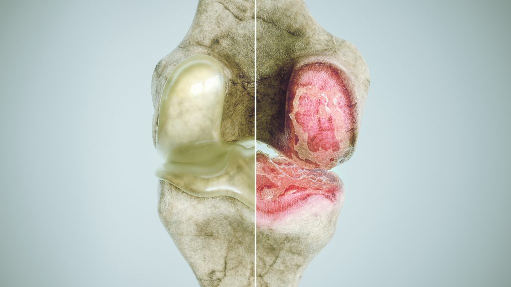 knee osteoarthritis anatomy
