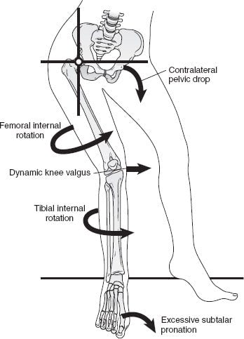 dynamic-knee-valgus-patellofemoral-pain-min