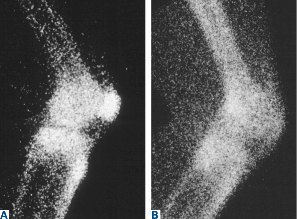 bone-scan-patellofemoral-joint-1024x754