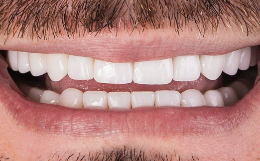 Close-up of a smiling mouth showing clean, straight white teeth and a mustache.