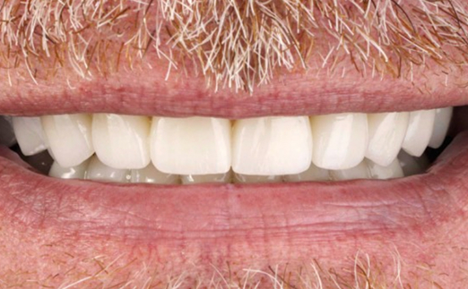 Close-up of a man's smile showing white teeth with facial hair around the mouth.