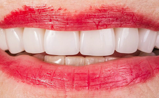 Close-up of a smile with red lipstick on lips showing clean, white teeth.