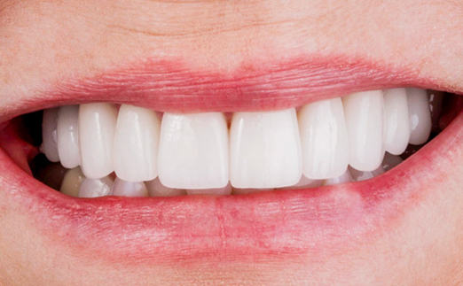 Close-up of a person smiling showing straight, white teeth.