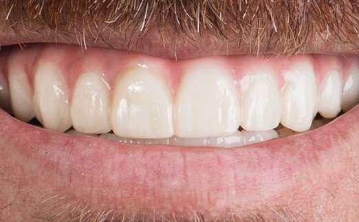 Close-up of a smiling mouth showing slightly spaced upper front teeth and a mustache above the lips.