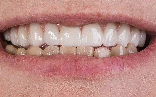 Close-up of a smile showing upper teeth with bright white veneers and lower teeth that are discolored and worn.