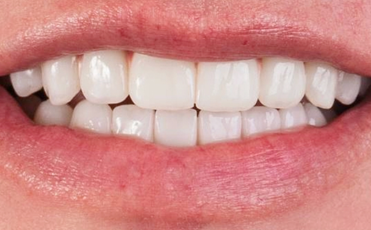Close-up of a person's mouth showing white, healthy teeth with a slight smile.