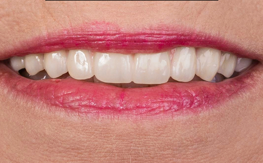 Close-up of a person's mouth showing slightly parted lips with pink lipstick and clean white teeth.