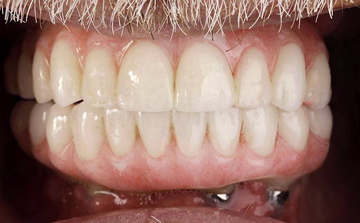Close-up of a person's mouth showing a full set of upper and lower dentures with a mustache above.