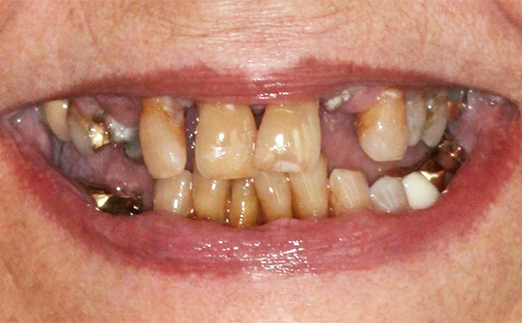 Close-up of a mouth with severely decayed, discolored, and misaligned teeth.