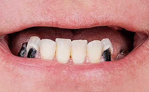 Close-up of a mouth showing upper front teeth with severe black tooth decay.