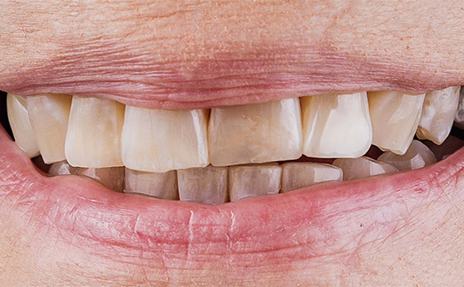 Close-up of a smiling mouth showing stained and uneven upper and lower teeth.