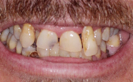 Close-up of a person’s mouth showing severely decayed, discolored, and damaged front teeth.