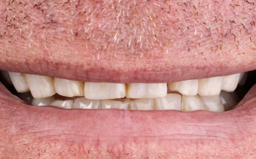 Close-up of a person's mouth showing partially closed lips and stained, slightly crooked teeth with visible gaps.