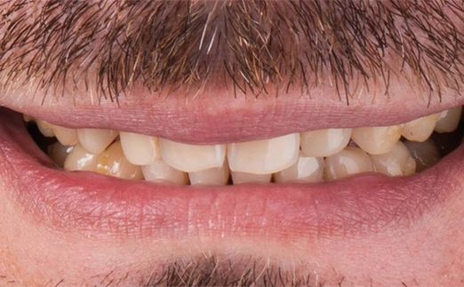 Close-up of a smiling mouth with visible stained and uneven teeth and a mustache above the upper lip.