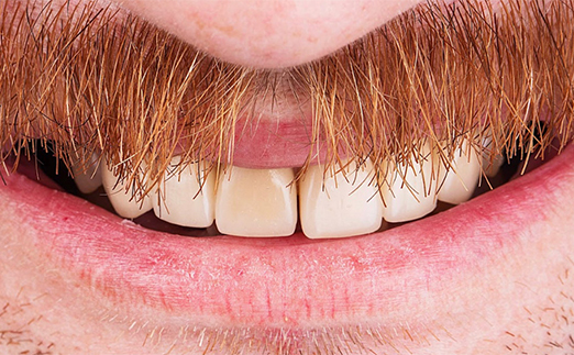 Close-up of a person's smile showing upper front teeth with a prominent reddish-brown mustache above the upper lip.