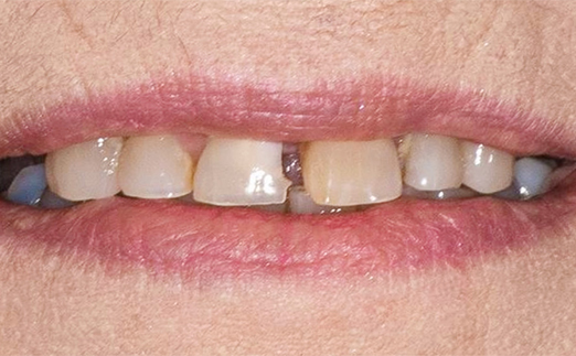 Close-up of a person's mouth showing upper front teeth with discoloration and gaps.