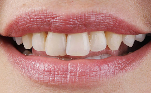 Close-up of a smiling person’s mouth showing natural teeth and lips with light pink lipstick.