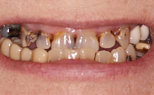 Close-up of a mouth with severely decayed and discolored teeth.