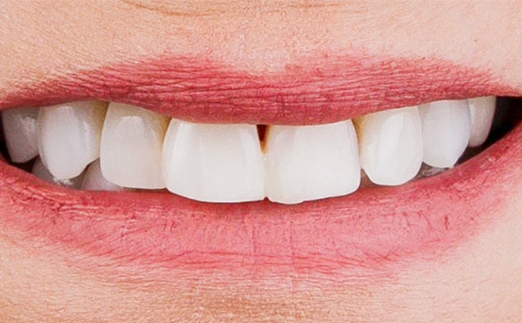 Close-up of a smiling mouth showing clean, straight upper teeth with slightly parted lips.