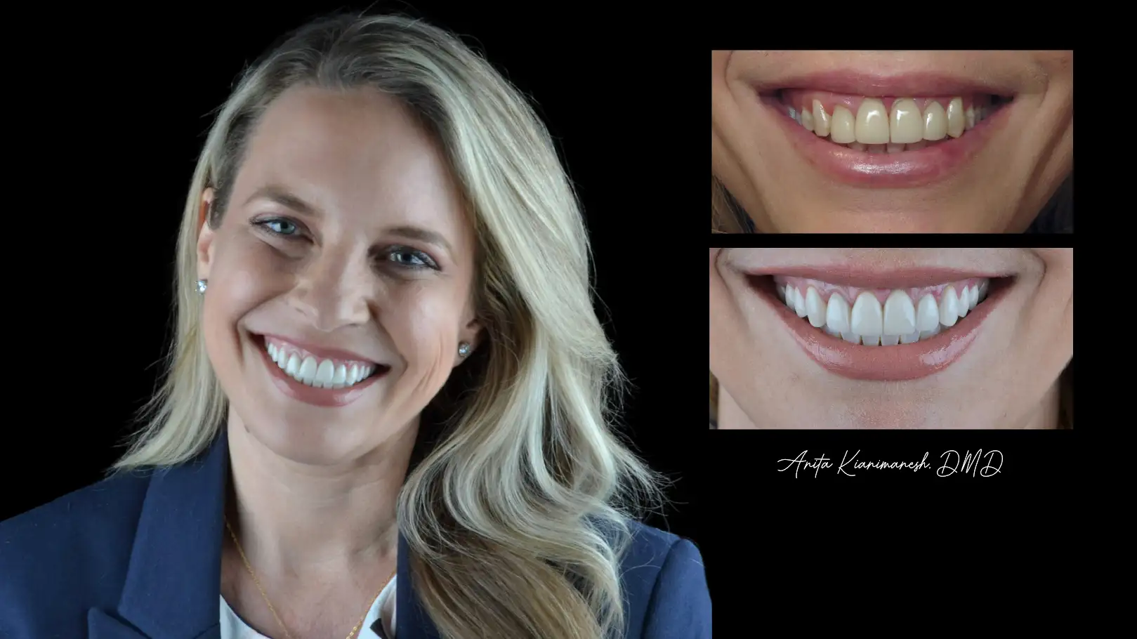 Crown/Veneers/Kur Whitening Restorations