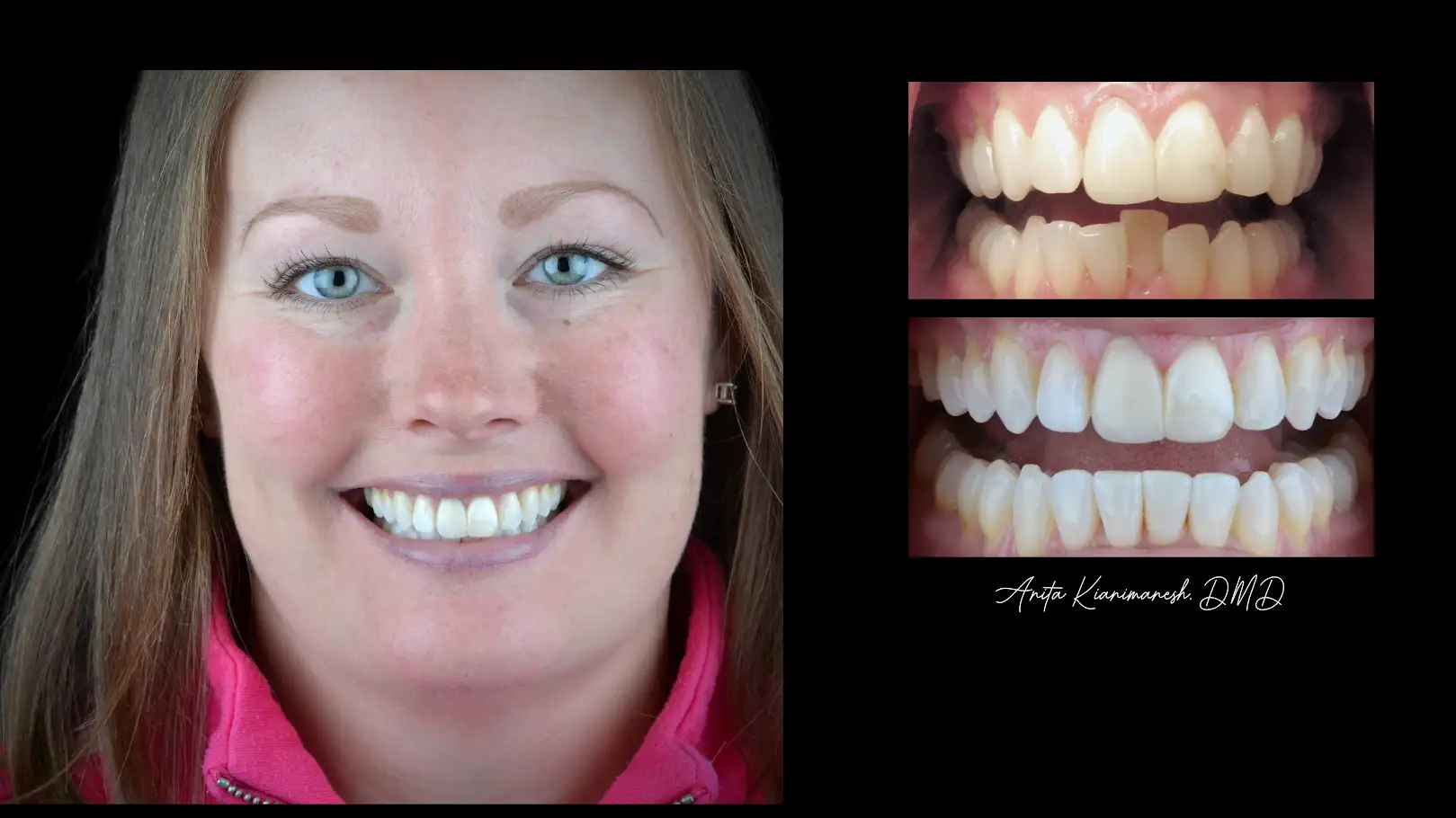 Invisalign and Whitening