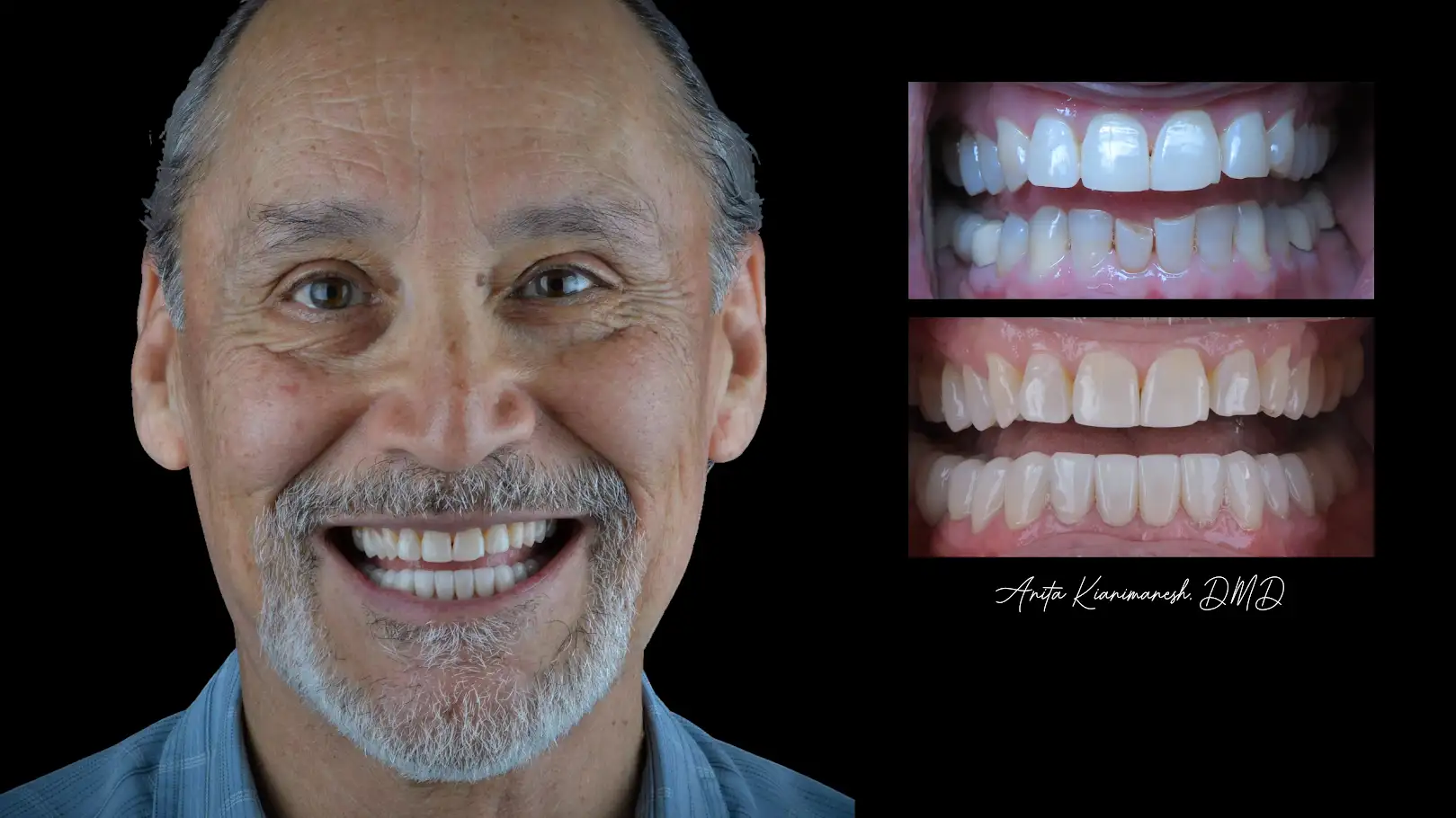 Lower Crowns 