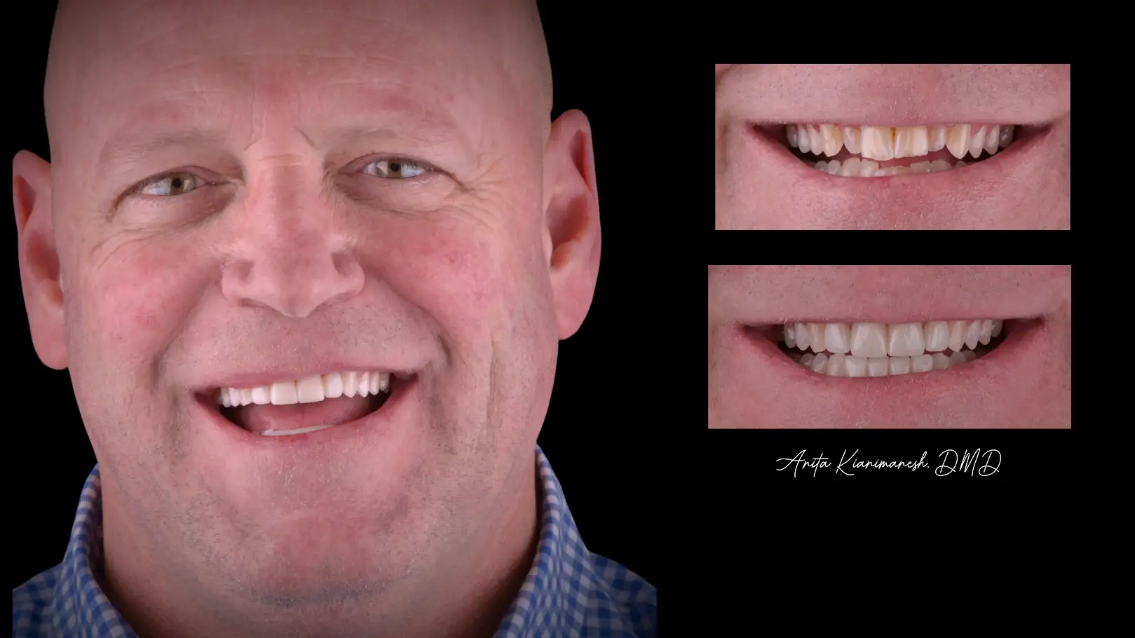 Veneers and Invisalign