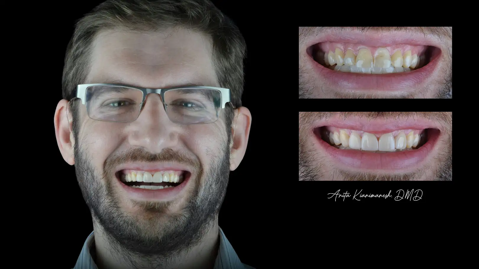 Restorative and Invisalign