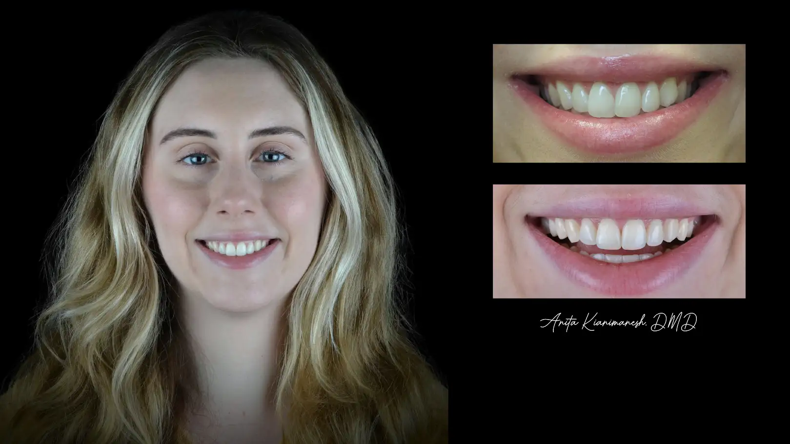 Invisalign