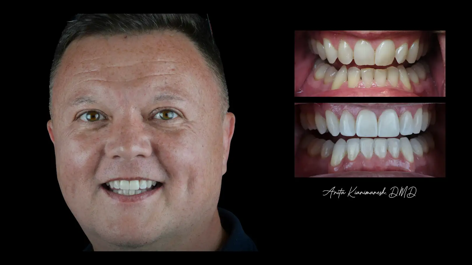 Invisalign and Chair Side Bonding Veneers
