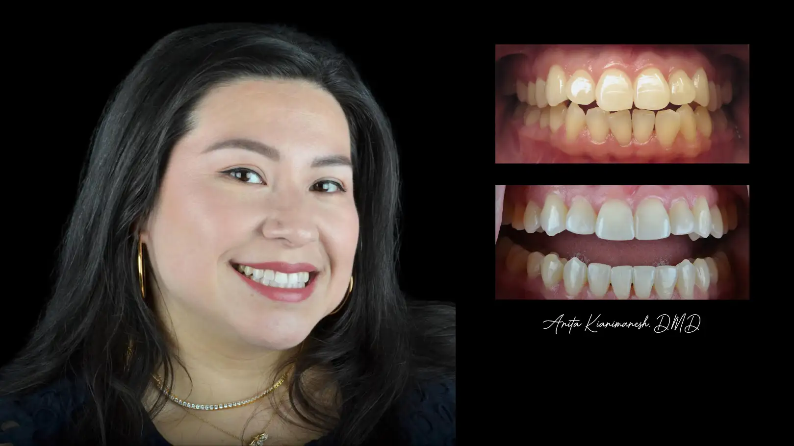 Invisalign 