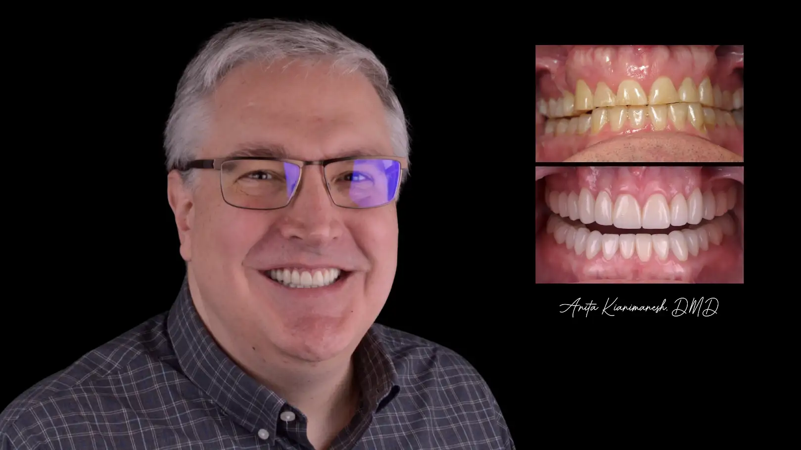  Full Mouth Reconstruction