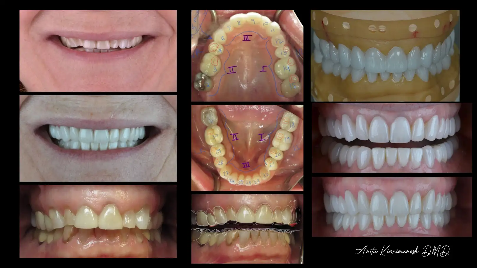 Full Mouth Reconstruction Process